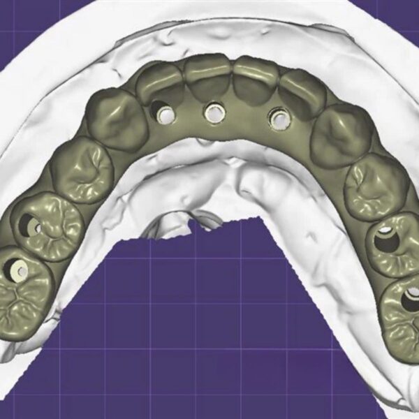 Screw retained implant bridge design with titanium bases CAD/CAM digital file ready for milling