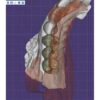 Professional dental bridge design CAD service - multi-unit bridge restoration for dental laboratories